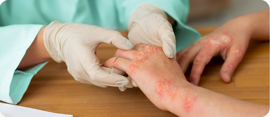 Psoriatic Arthritis image